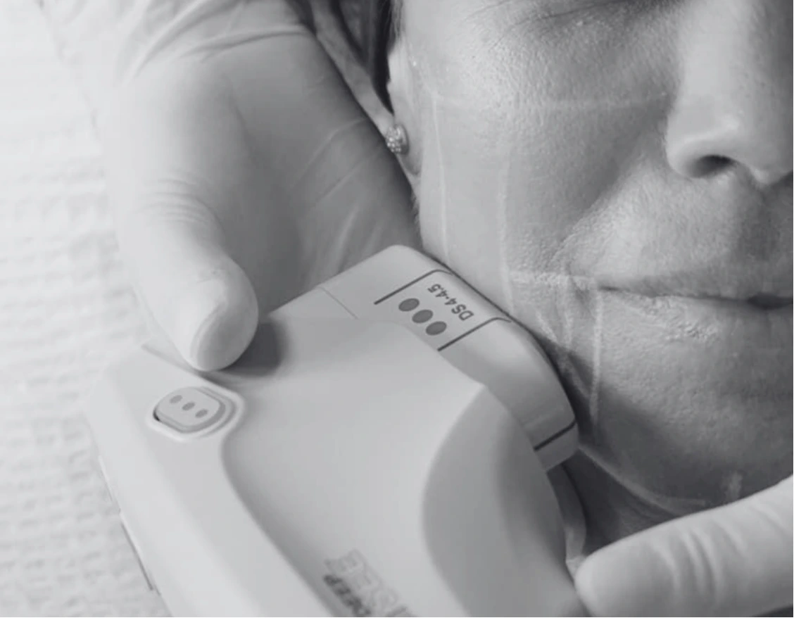 ULTHERAPY