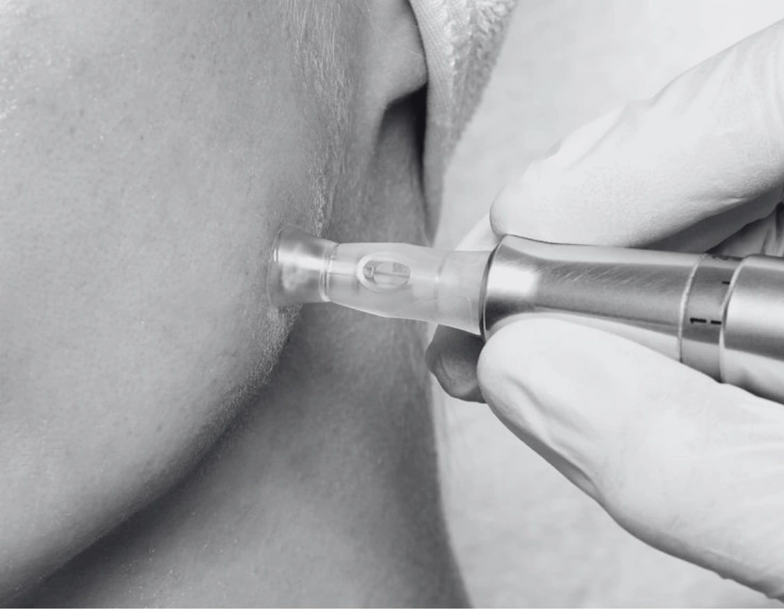 MICRONEEDLING
