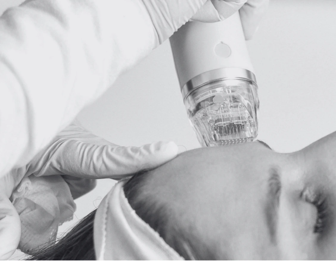 SECRET RF MICRONEEDLING