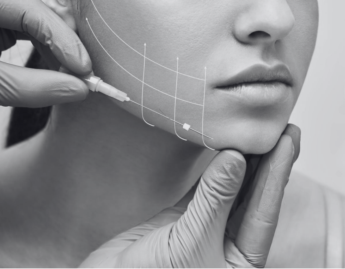 PDO THREAD FACE LIFT