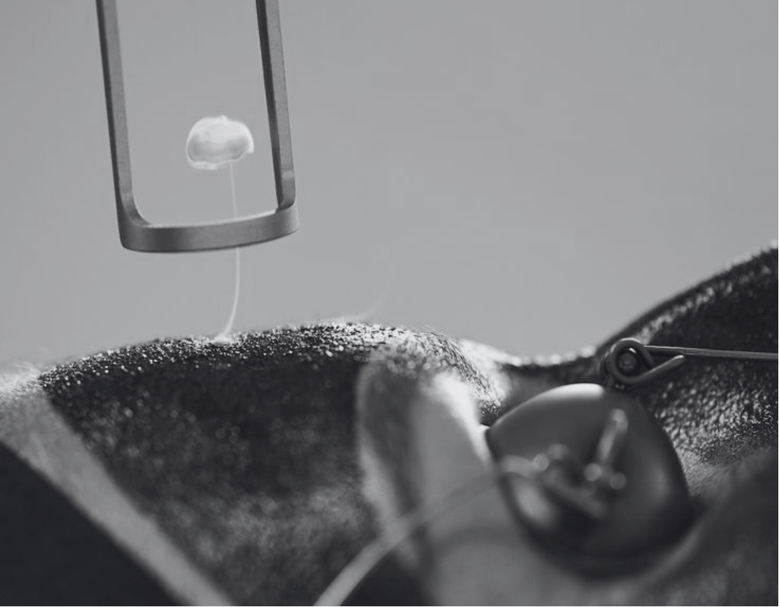 CARBON LASER PEEL FACIAL