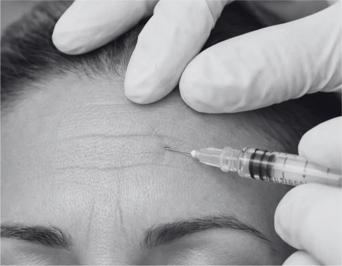 BOTOX INJECTION