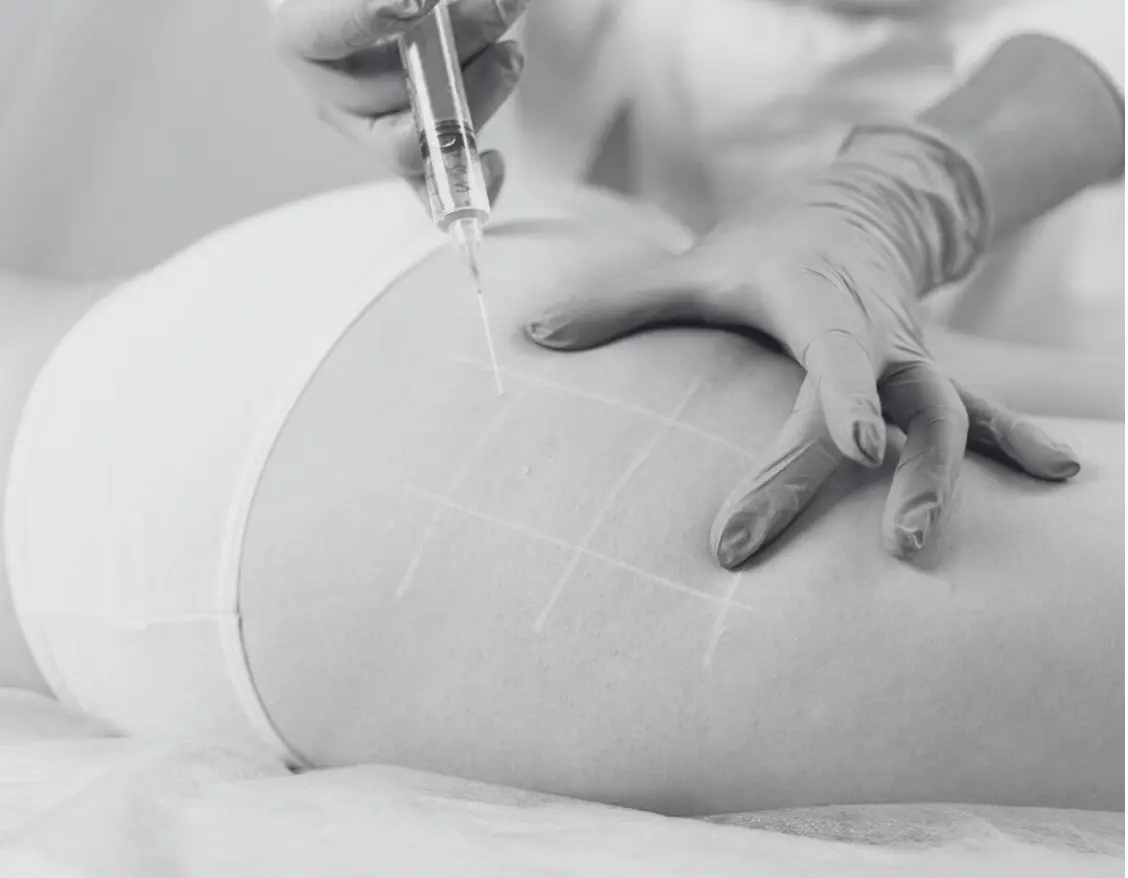 QWO CELLULITE TREATMENT