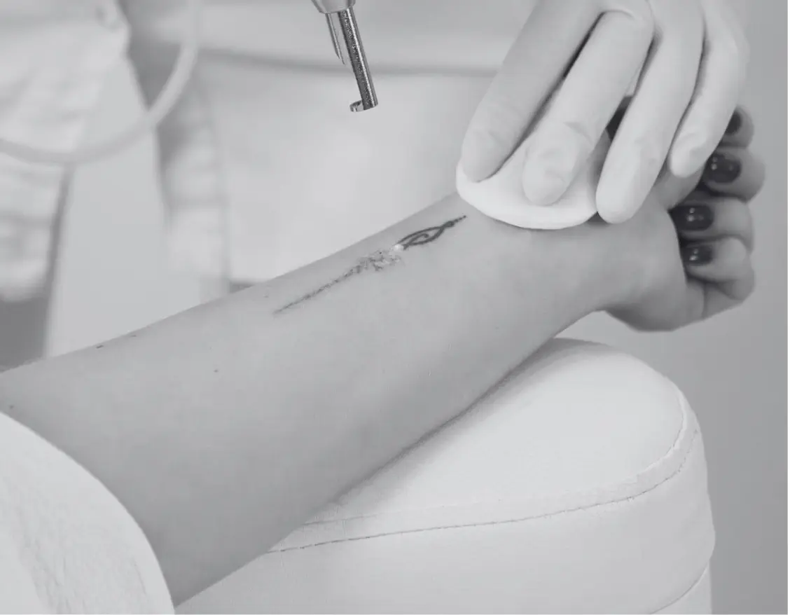 LASER TATTOO REMOVAL