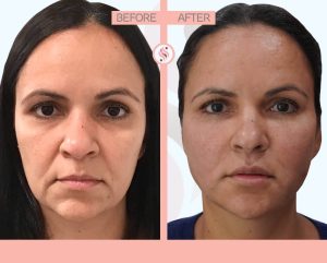 PDO ThreadLift
