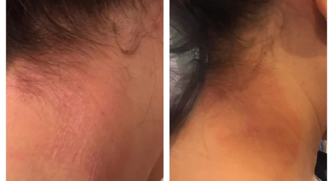 before and after results of moisturizer for stretch marks