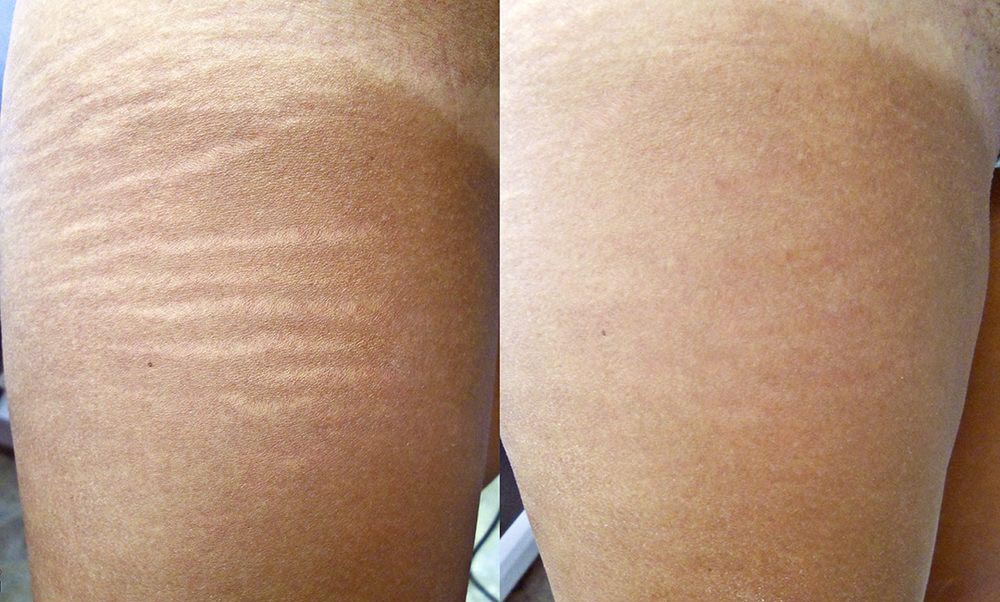 before and after results of treating stretch marks with radiofrequency microneedling
