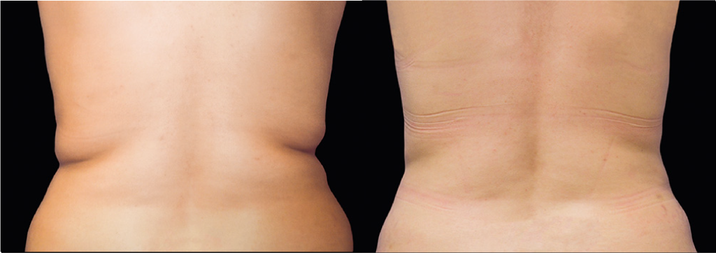 CoolSculpting treatment NYC