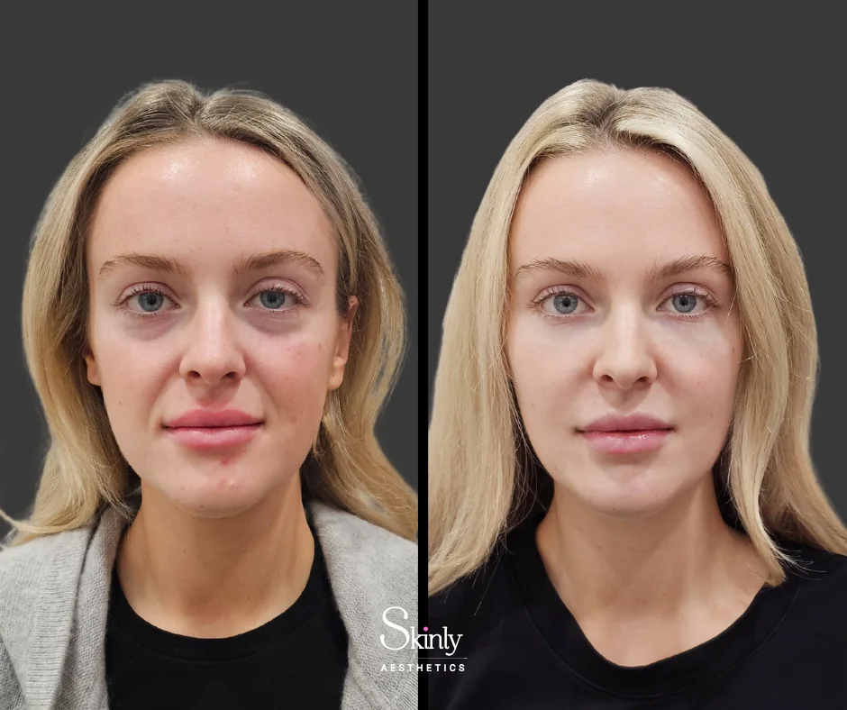 Dramatic facial rejuvenation with a liquid facelift performed by Dr. Schwarzburg